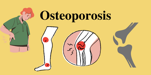 Osteoporosis Causes and Risk Factors